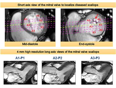 Cardiac Imaging for Risk Assessment of Malignant Ventricular Arrhythmias in Patients With Mitral Valve Prolapse